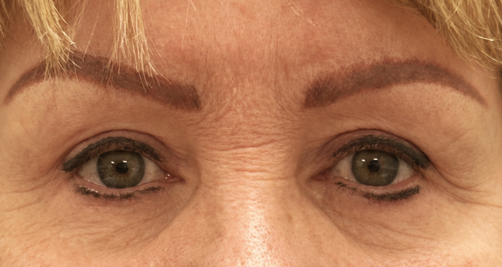 After blepharoplasty, patient 1