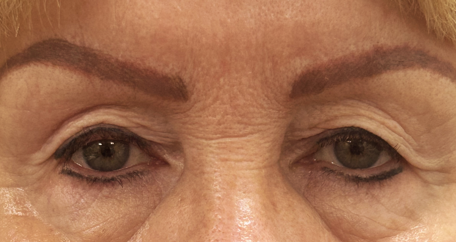 Before blepharoplasty, patient 1