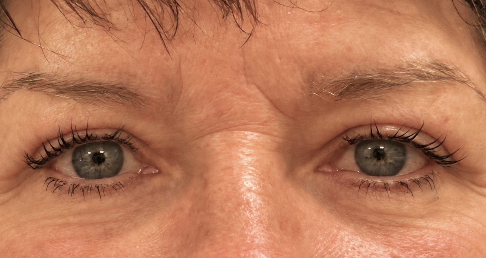 After blepharoplasty, patient 2