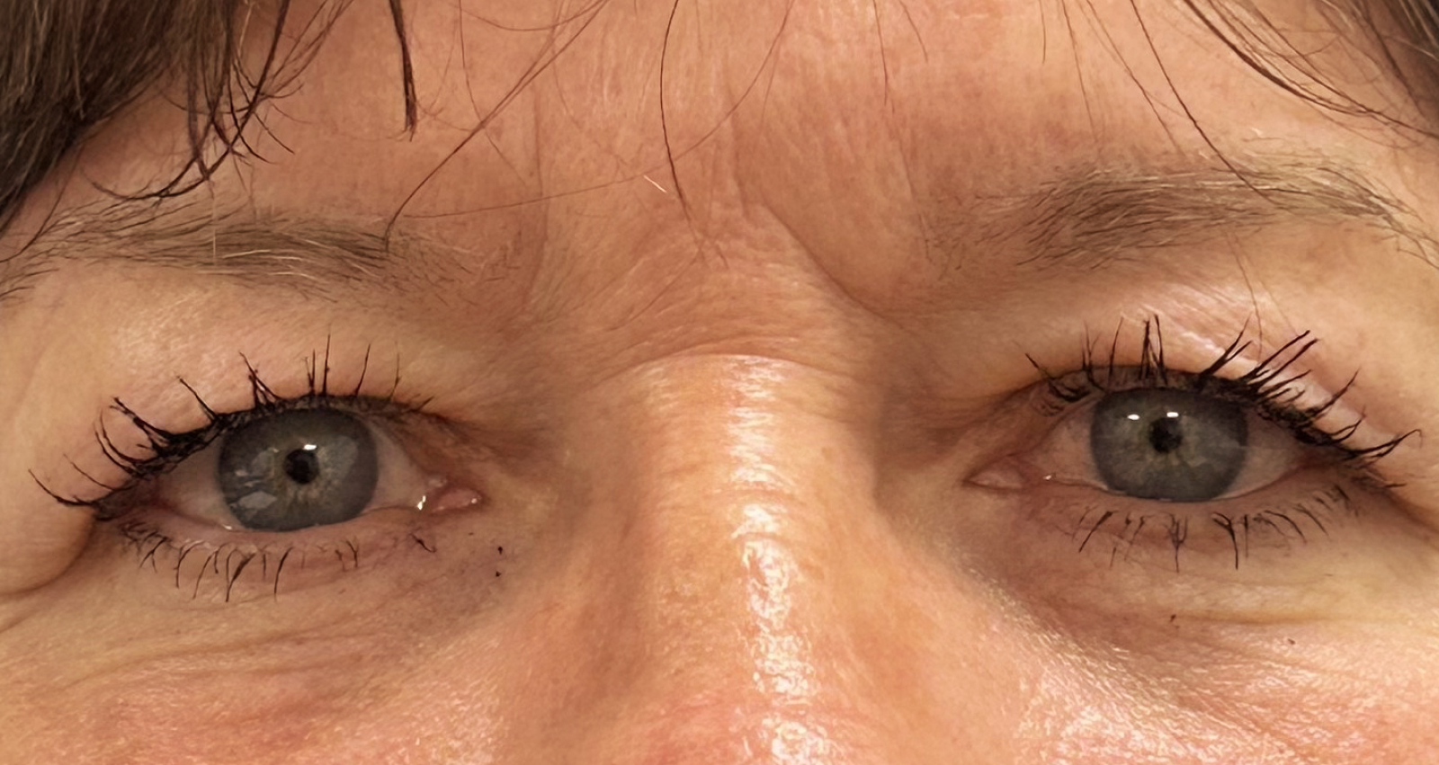 Before blepharoplasty, patient 2