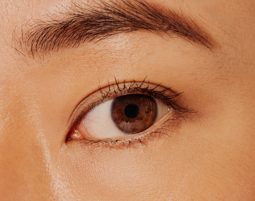 A hollow shadowed area under the eye where volume has been lost