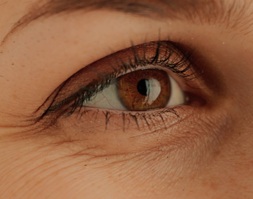 Lower eyelid showing puffiness beneath the eye