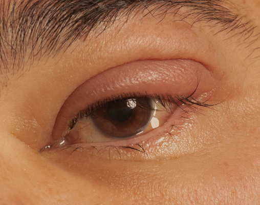 A small raised lesion sitting on the margin of the eyelid