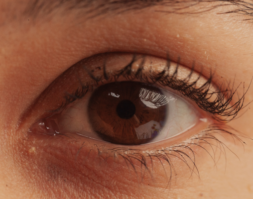 A watering eye with moisture gathering at the inner corner