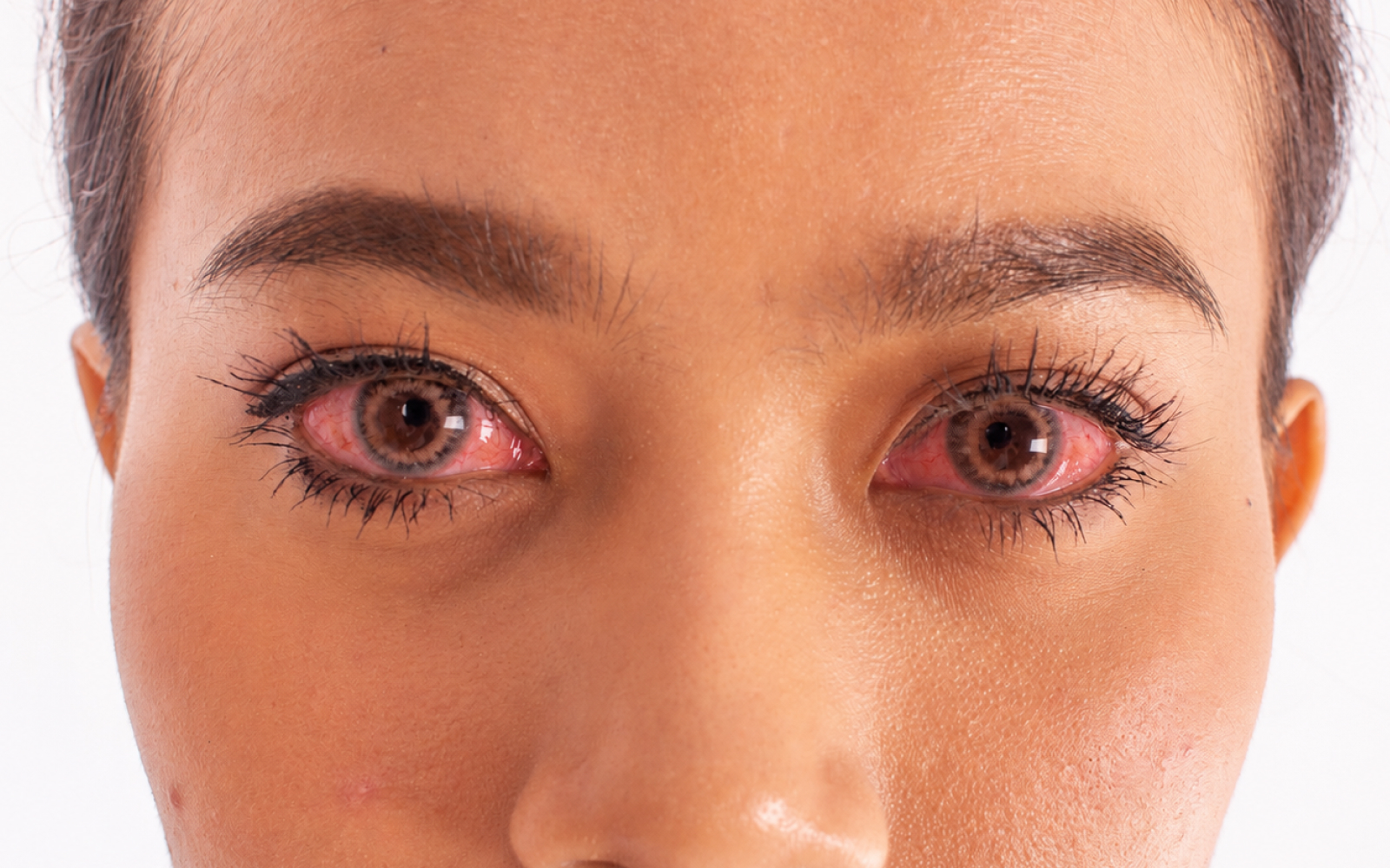 The same eye six weeks after upper blepharoplasty